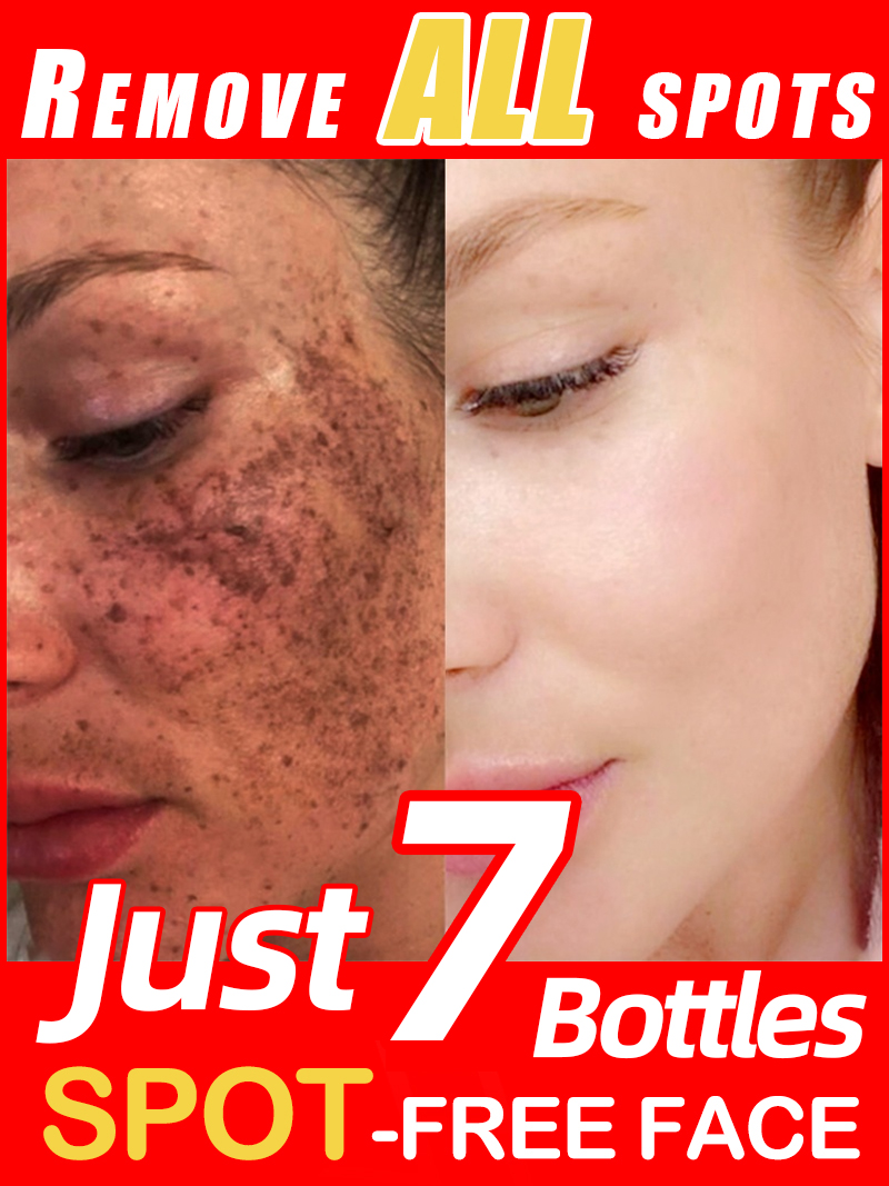 Ultra Luxury Skincare - Éclairer les taches de rousseur Melasma,